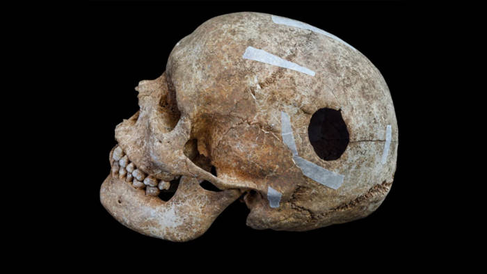 Skull showing large trepanation hole.