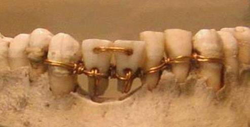 Trabajo dental de momia - 4000 años