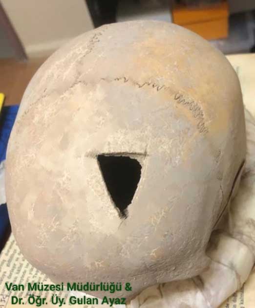 The newly discovered trepanned skull found in Turkey, dating back to the Iron Age.  What will we learn about ancient brain surgery?  (Ministry of Culture and Tourism, Turkey)