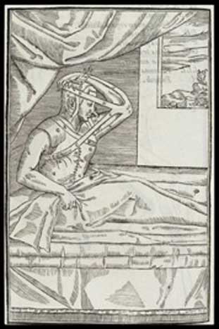 A patient undergoing Tagliacozzi’s procedure for fixing saddle-nose. 