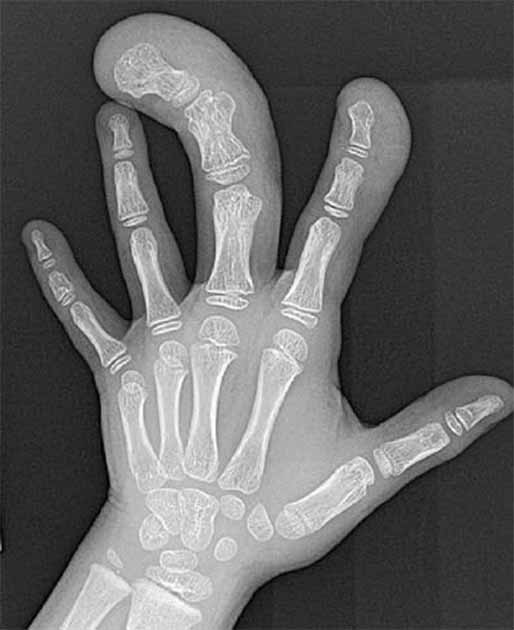 A radiograph of the left hand showing Macrodystrophia. (Dillman, J.R., Strouse, P.J. Macrodystrophia lipomatosa/Pediatr Radiol 40, 372 (2010))