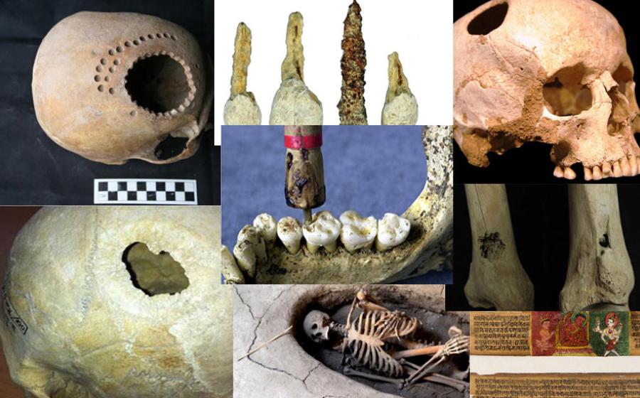 Eight Impressive but Terrifying Cases of Ancient Surgery