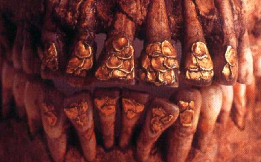 Gold inlaid teeth of the Bolinao Skull.  Source: National Museum of the Philippines