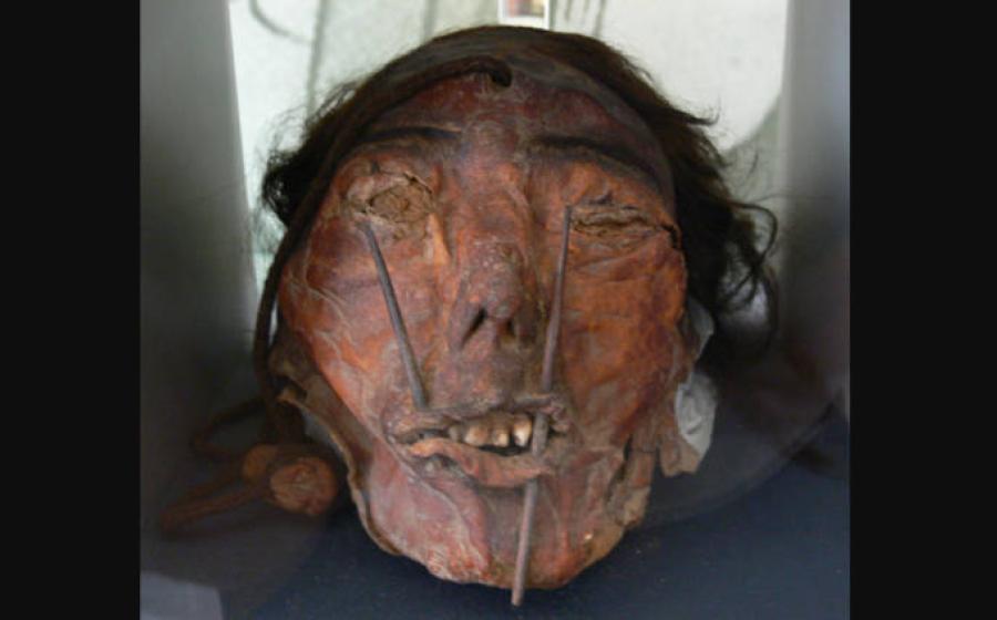 A trophy head from the Nazca culture found to be man with cleft lip.  