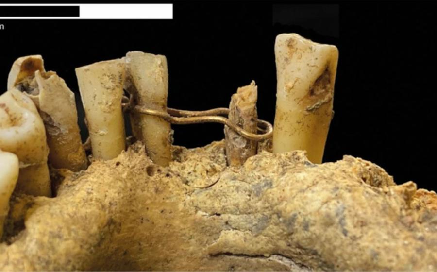 Gold wire ligature on the mandible of the medieval man found at St Nicholas Kirk, Aberdeen
