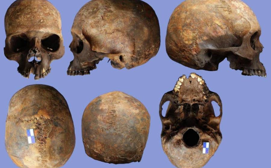 Skull 2N showing evidence of rare Apert syndrome.