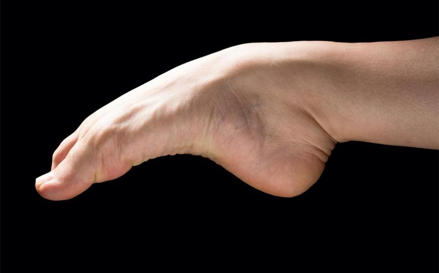Image of human foot demonstrating the arch.          Source: Alessandro Grandini