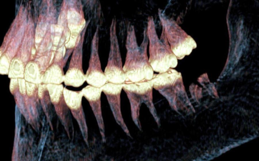 Xray of the jaw of the Pazyryk mummy found to have had jaw surgery.