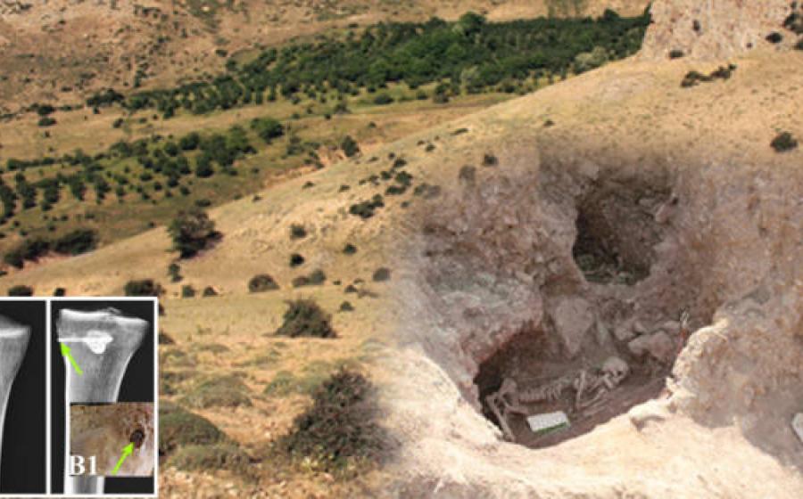 Archaeological excavation work at Liyarsangbon Cemetery site. Inset, Image of the tibia bone with an embedded arrowhead. 