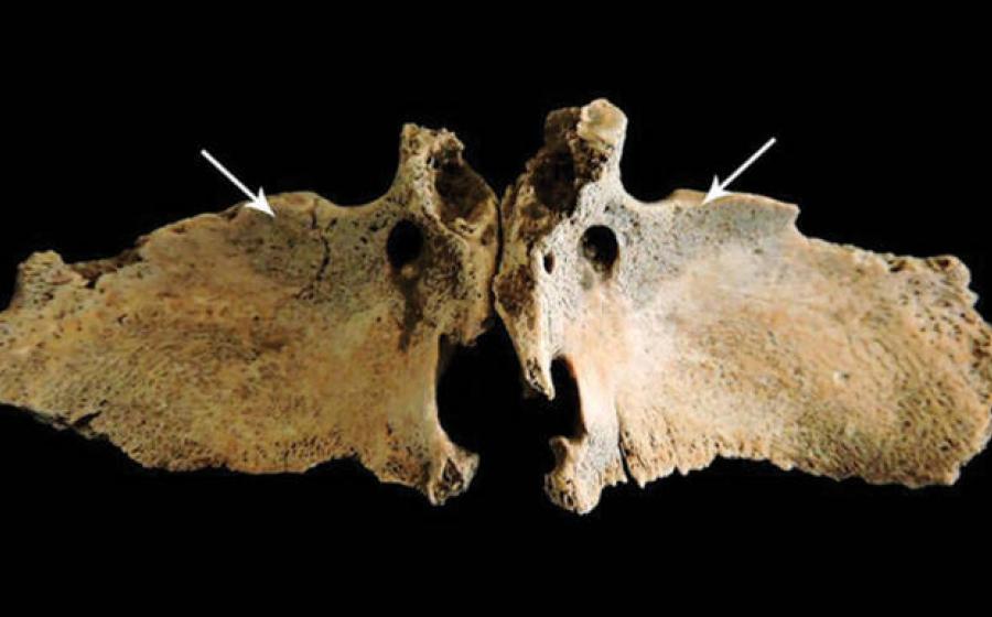 New bone on the greater wings of the sphenoid bone, suggestive of vitamin C deficiency in Roman Briton. 