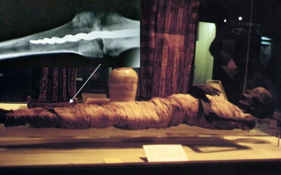 Usermontu's Knee Screw Baffles Experts: 2,600-Year-Old Medical Marvel 