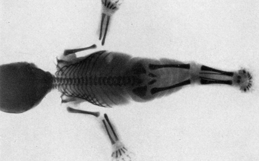 Are Mermaid Myths Inspired by a Rare Medical Condition?