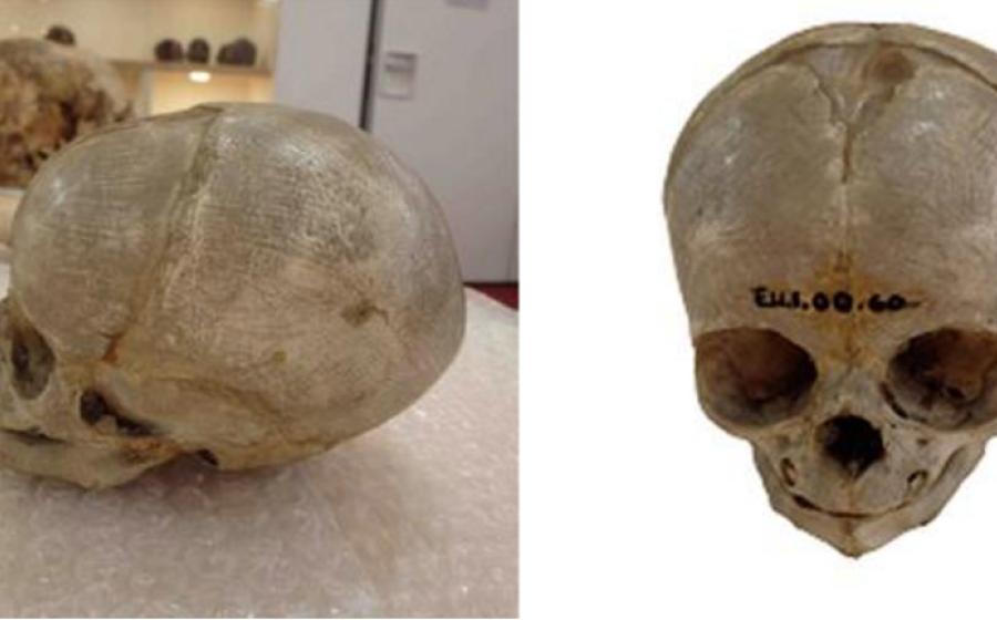 issected foetal skull dating from the 1800s, originally held in the University of Cambridge Anatomy Museum.