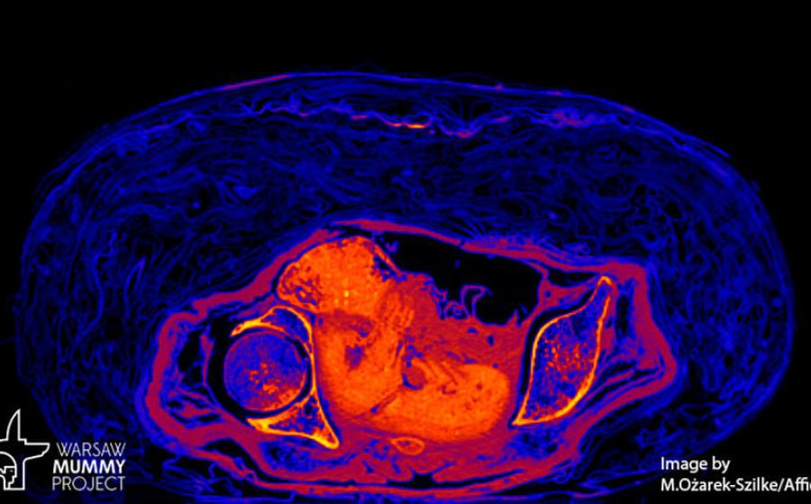 Scan of the mummified fetus discovered within the pregnant mummy. Source: Warsaw Mummy Project 