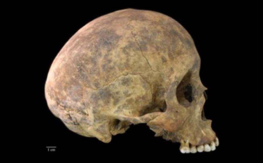 One of two cases of healed blows to the cranium from the Playa Venado excavations. 	Source: Nicole Smith-Guzmán, STRI
