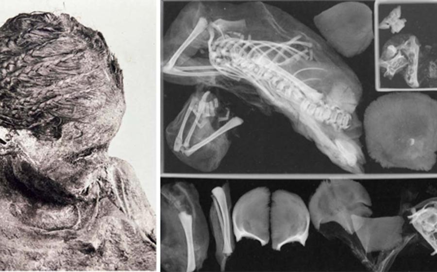 The teenage girl, who was not more than 17 years old, was buried alongside the decapitated baby in a tomb. This led experts to speculate that she might have been unaware of her pregnancy with twins. Right; Rradiograph of mummified fetus found lodged within the teenage girl’s pelvis.  Source: Francine Margolis, David R. Hunt/onlinelibrary.wiley.com