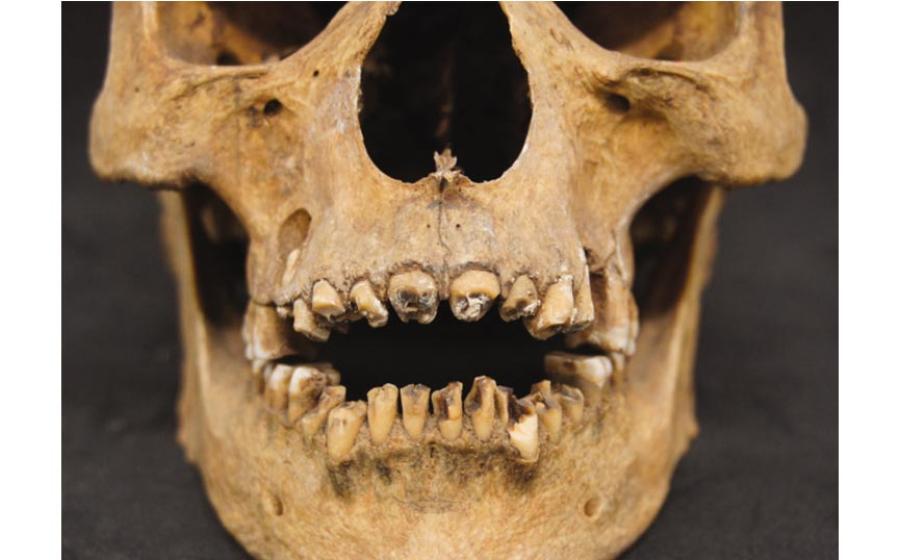 The teeth of a 17th dynasty (circa 1550 BC) mummy had his teeth broken out, probably during the embalming process. This mummy's wrappings were removed in the early 20th century. 