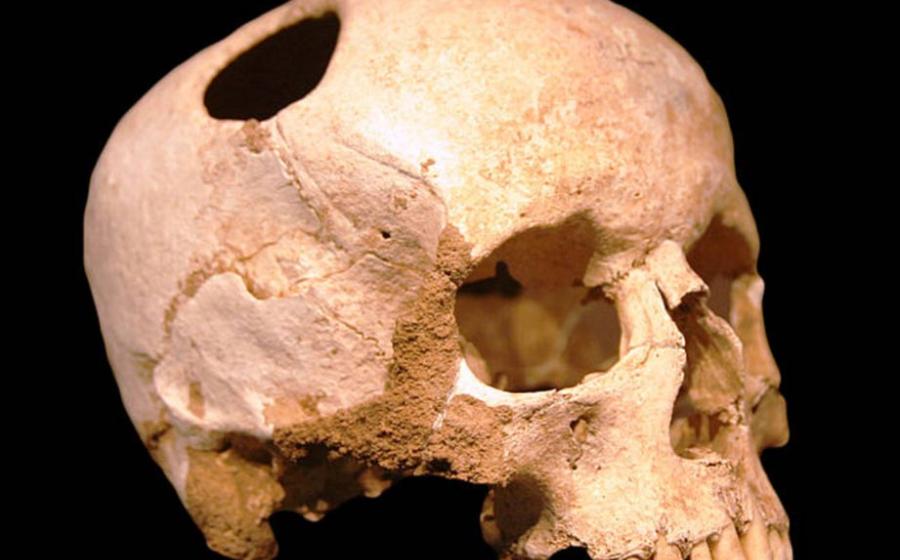 A trepannated skull from Neolithic period