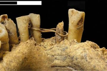 Gold wire ligature on the mandible of the medieval man found at St Nicholas Kirk, Aberdeen