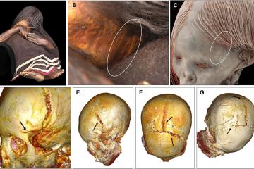 External photographs and CT-based three-dimensional reconstructions of the Cerro El Plomo child mummy reveal cranial fractures consistent with a fatal head injury sustained shortly before death during the Inca Capacocha ritual