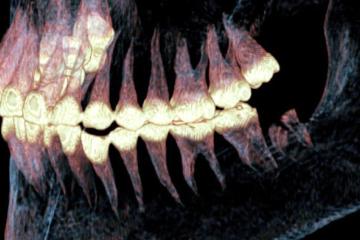 Xray of the jaw of the Pazyryk mummy found to have had jaw surgery.