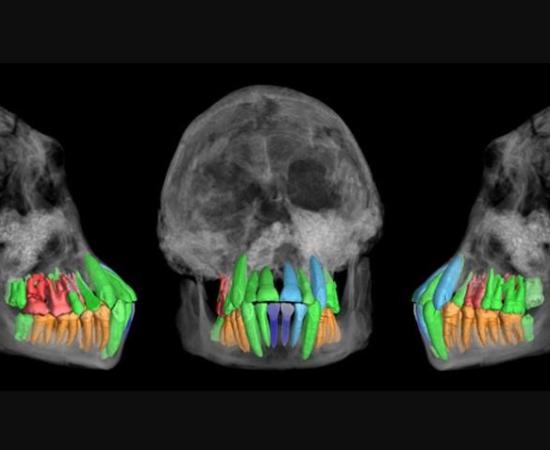 Skull and dentition of a young individual of early Homo from Dmanisi