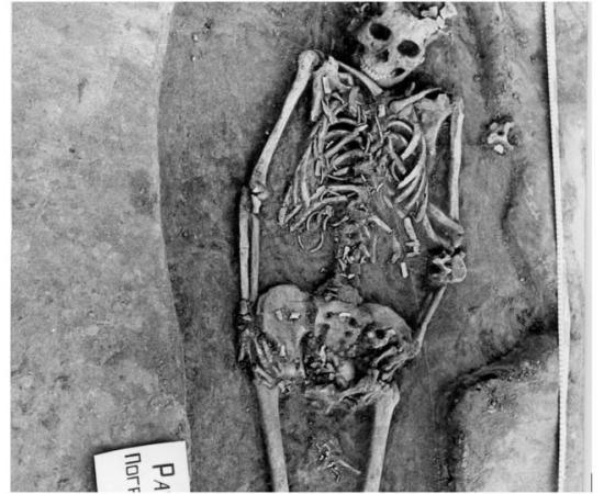 Researchers said the bones of this woman's twin fetuses are visible near her pelvis and thighs