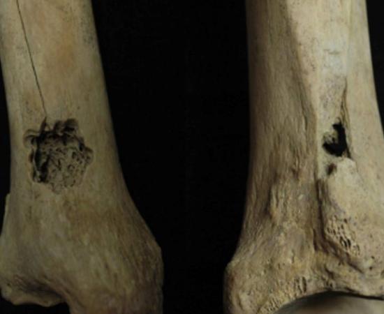 First Ever Evidence for Ancient Bone Surgery found in Peru