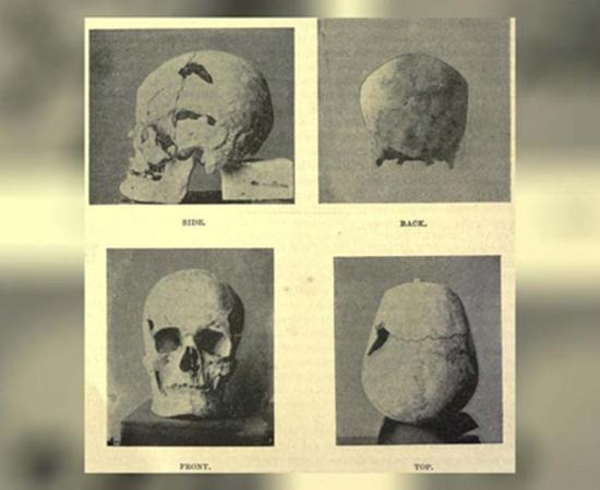 The skull of the Egyptian pharaoh Sa-Nakht, who may have had gigantism