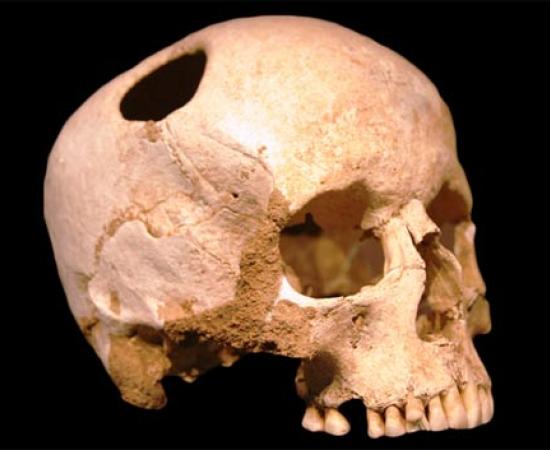 Ancient Pazyryk nomads - Cranial Surgery