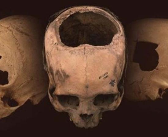 More ancient skulls bearing evidence of trepanation - a tell-tale hole surgically cut into the cranium - have been found in Peru than the combined number found in the rest of the world. 