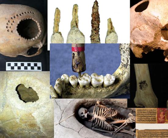 Eight Impressive but Terrifying Cases of Ancient Surgery