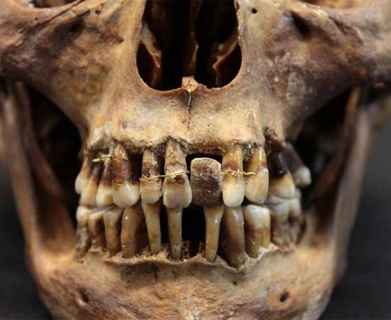 The Skull of Anne d’Alegre, countess of Laval (1565-1619) equipped with hippo bone dental prostheses and gold wire. Source: Rozenn Collator / Inrap