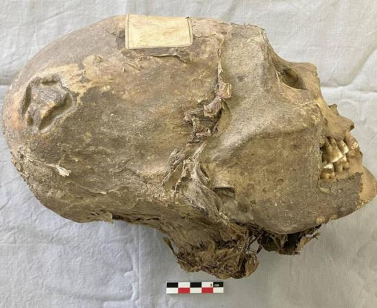 Right lateral view of the individual with cranial deformation.  