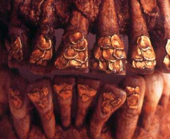Gold inlaid teeth of the Bolinao Skull.  Source: National Museum of the Philippines