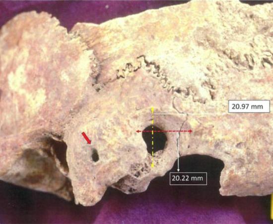 Ectocranial view of the brain surgery of paleopathological specimen: a) red arrow points to orifice on the mastoid process, and b) surgical preparation dimensions peripheral to trephination.         Source: Anagnostis P. Agelarakis / Adelphi University