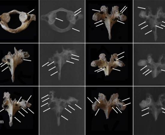 Scientists have discovered one of the earliest cases of multiple myeloma, a malignant cancerous tumor, found to date in East Asia within skeletal remains that date back to Bronze Age China. The image shows osteolytic lesions visible on photographs and X-rays of vertebrae. Source: Jenna Dittmar / Science Direct