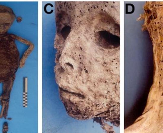 (B) the child’s mummified body prior to the autopsy, (C) the pockmarked face and (D) this rash as evident on the arm. 