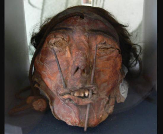 A trophy head from the Nazca culture found to be man with cleft lip.  