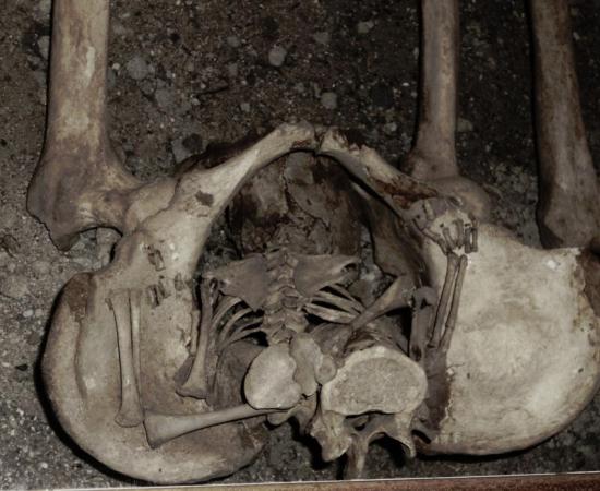 A possible example of a ‘coffin birth’.