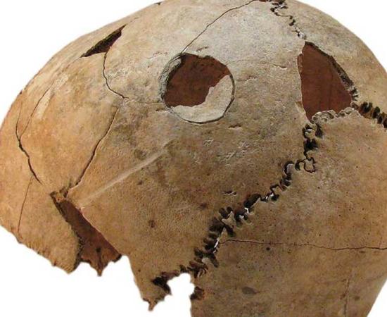 This skull from a teen boy, found at the Croatian massacre site, clearly shows blunt force injuries in two locations.
