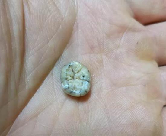 Evidence of Denisovans in Southeast Asia is growing one tooth at a time based on the recent find in Laos. The molar attributed to a young female individual of the extinct human species called the Denisovans was found in cave Tam Ngu Hao 2 in northeastern Laos.	Source: Fabrice Demeter / Handout via Reuters