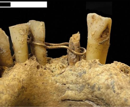 Gold wire ligature on the mandible of the medieval man found at St Nicholas Kirk, Aberdeen