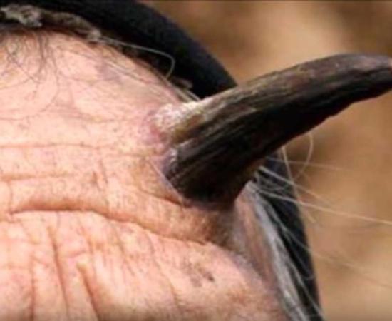 Sebaceous horn or ‘Devil’s Horn’.      Source: You Tube