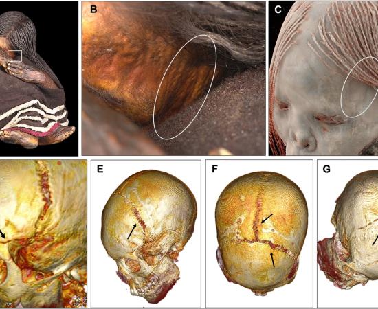 External photographs and CT-based three-dimensional reconstructions of the Cerro El Plomo child mummy reveal cranial fractures consistent with a fatal head injury sustained shortly before death during the Inca Capacocha ritual