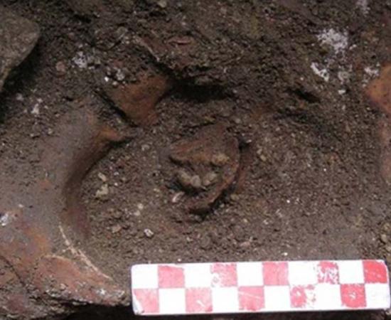 The tumor with teeth was found in a cemetery in Lisbon, Portugal. 