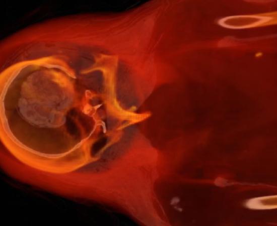 The head and upper thorax of Hatason (Fine Arts Museum of San Francisco)