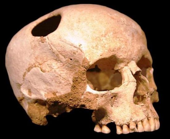 Representational image showing trepanation. A trepanated skull of a girl from the Neolithic period (3500 BC); the patient survived. Natural History Museum, Lausanne, Switzerland.