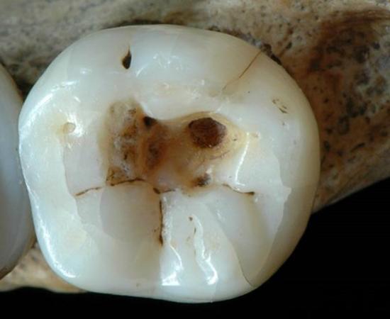 Infected tooth partially cleaned with flint tools, dating to the Late Upper Paleolithic. It is credited as the oldest found evidence of dentistry.