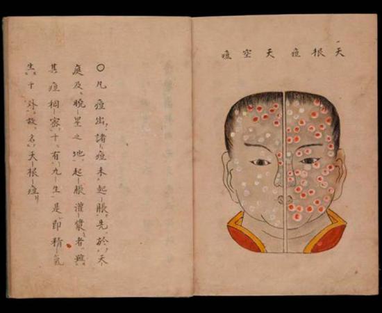 Japanese illustration of smallpox, dating back to 1720, from a work entitled Toshin seiyo, or The essentials of Smallpox. Source: Wellcome Collection / Public Domain